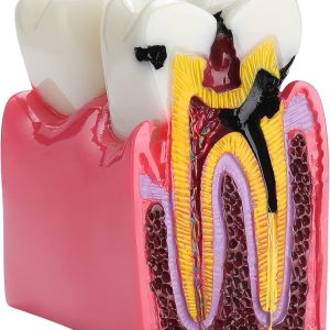 Caries Model